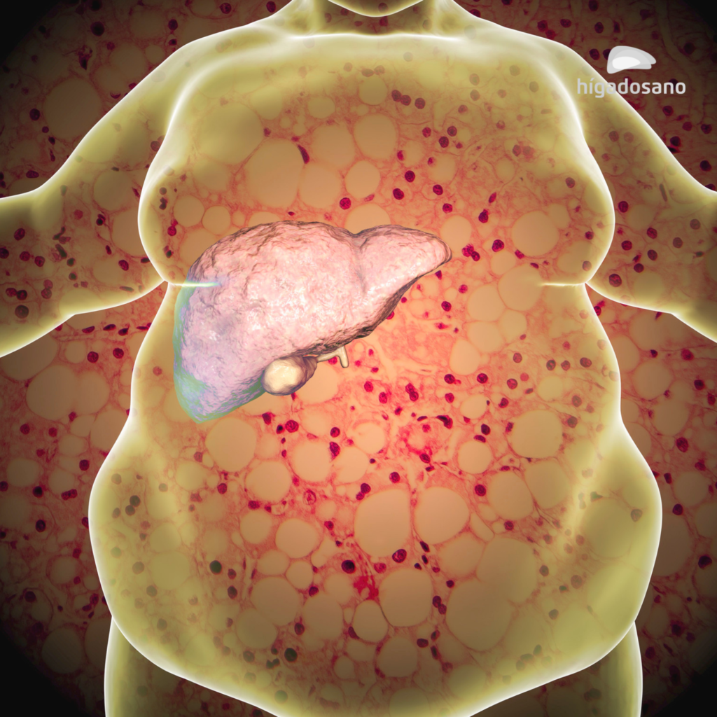 ¿Cómo afecta la obesidad al hígado?