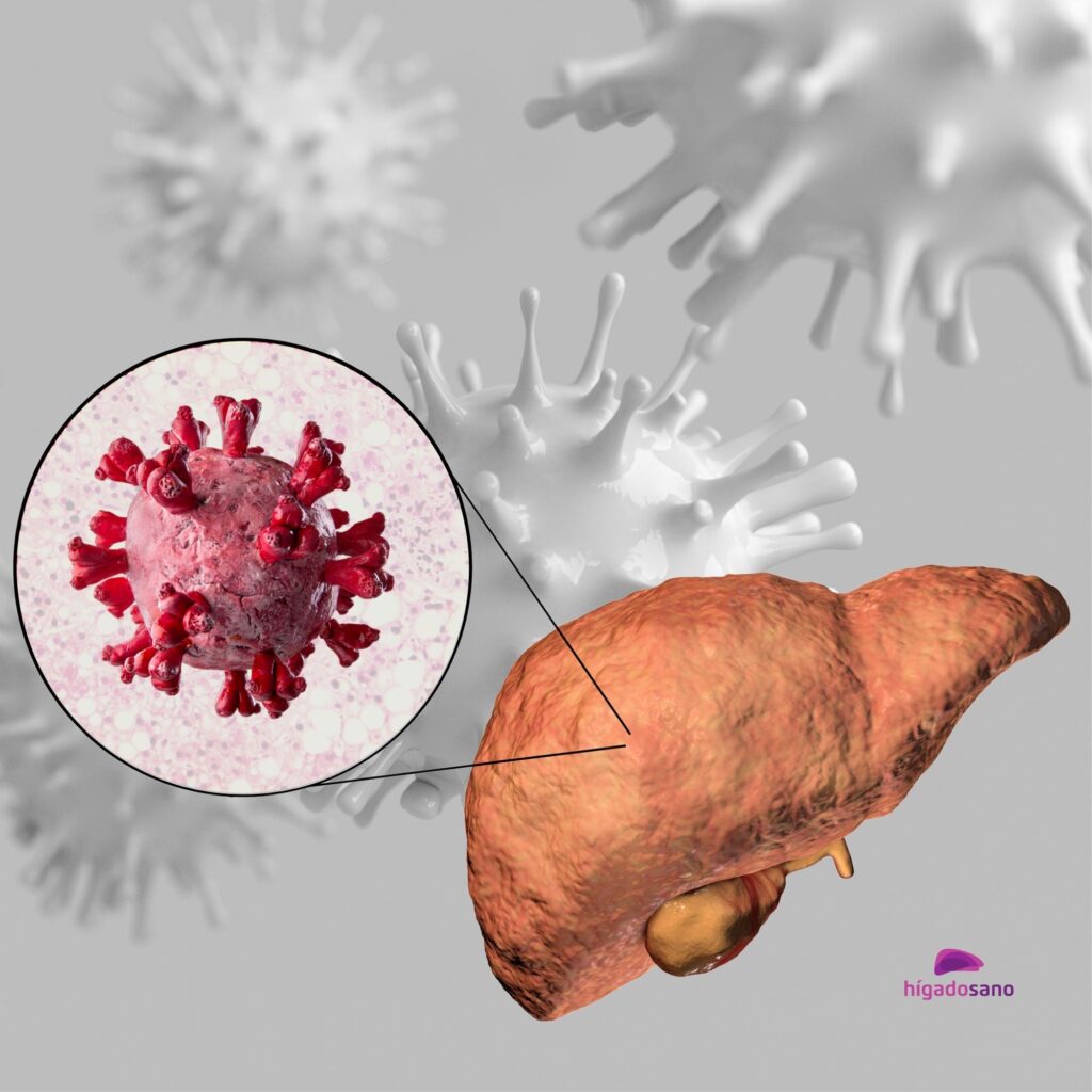 Hígado graso ¿Una manifestación de Long Covid?