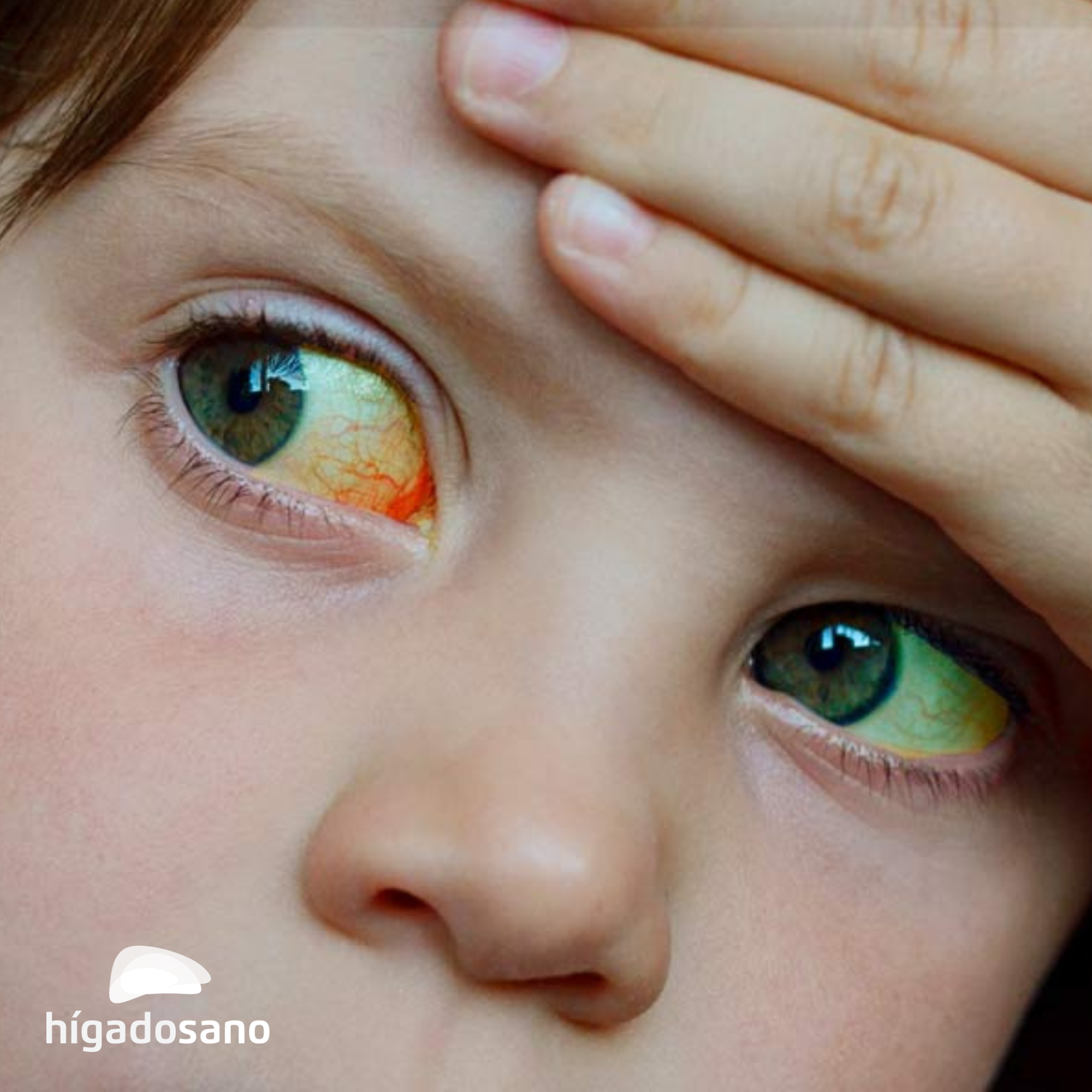 viruela del mono en niños