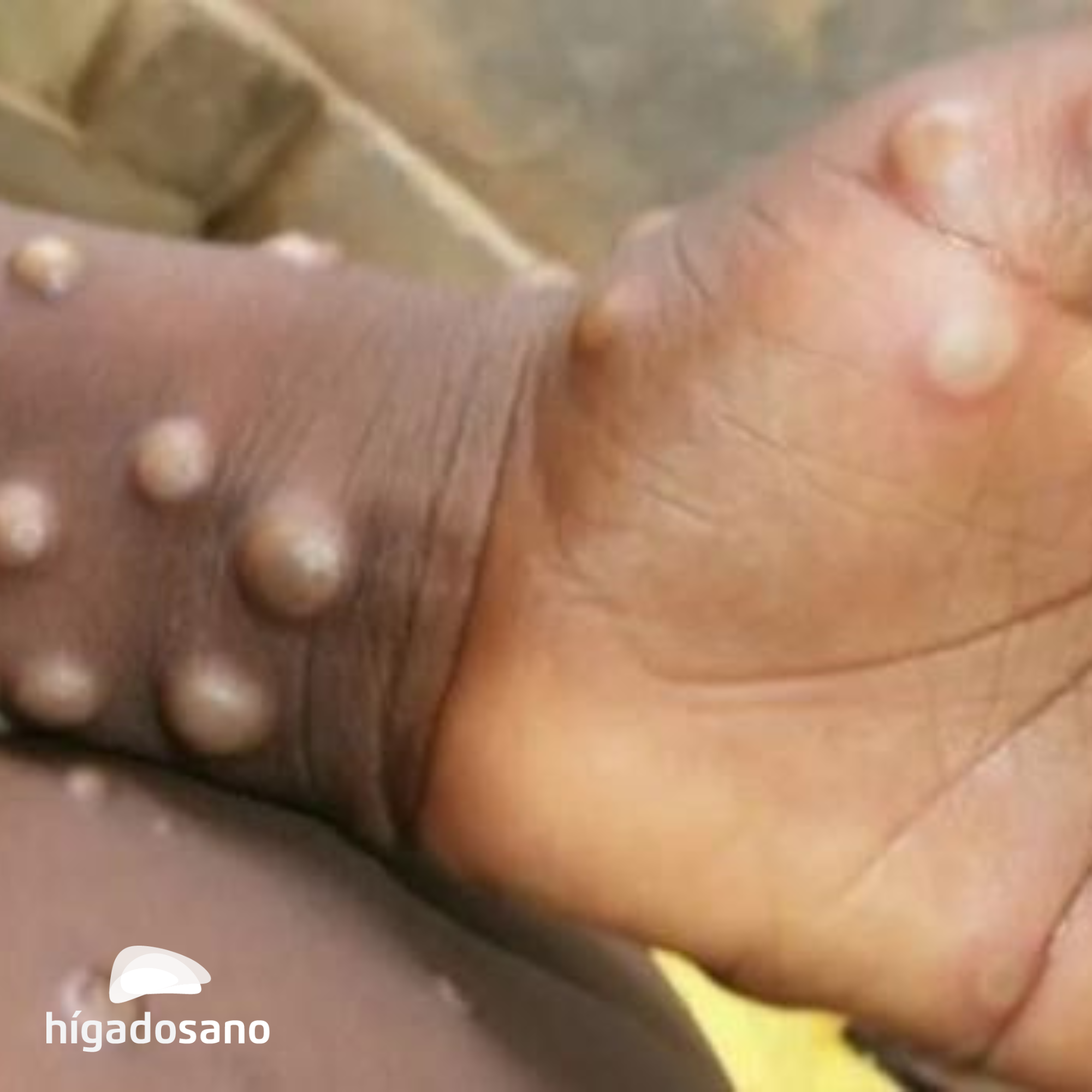 relacion entre viruela simica y coronavirus