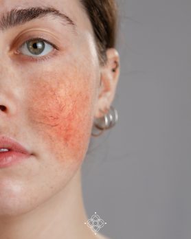 Acné y rosácea que no quitan las cremas: Falla en tu digestión que nadie te dijo